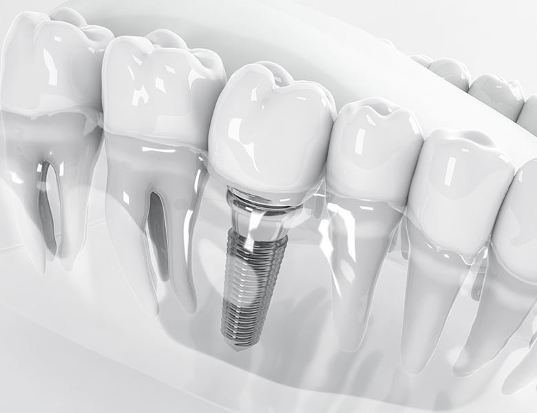東十条の歯医者、医療法人社団医智会 Premium Dental Salon IKEIのインプラント