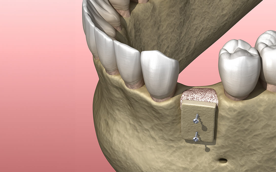 東十条の歯医者、医療法人社団医智会 Premium Dental Salon IKEIのインプラント