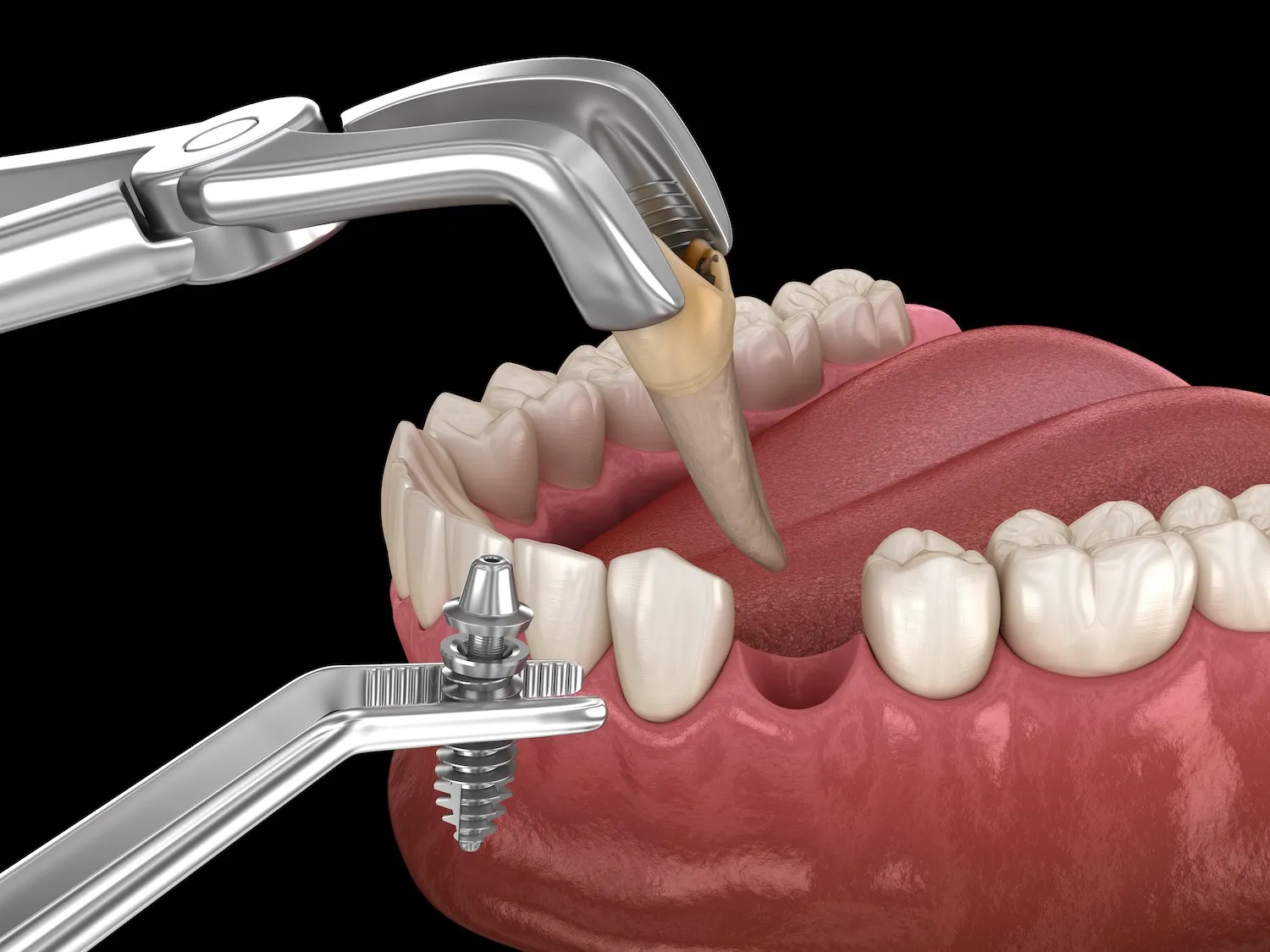 東十条の歯医者、医療法人社団医智会 Premium Dental Salon IKEIのインプラント