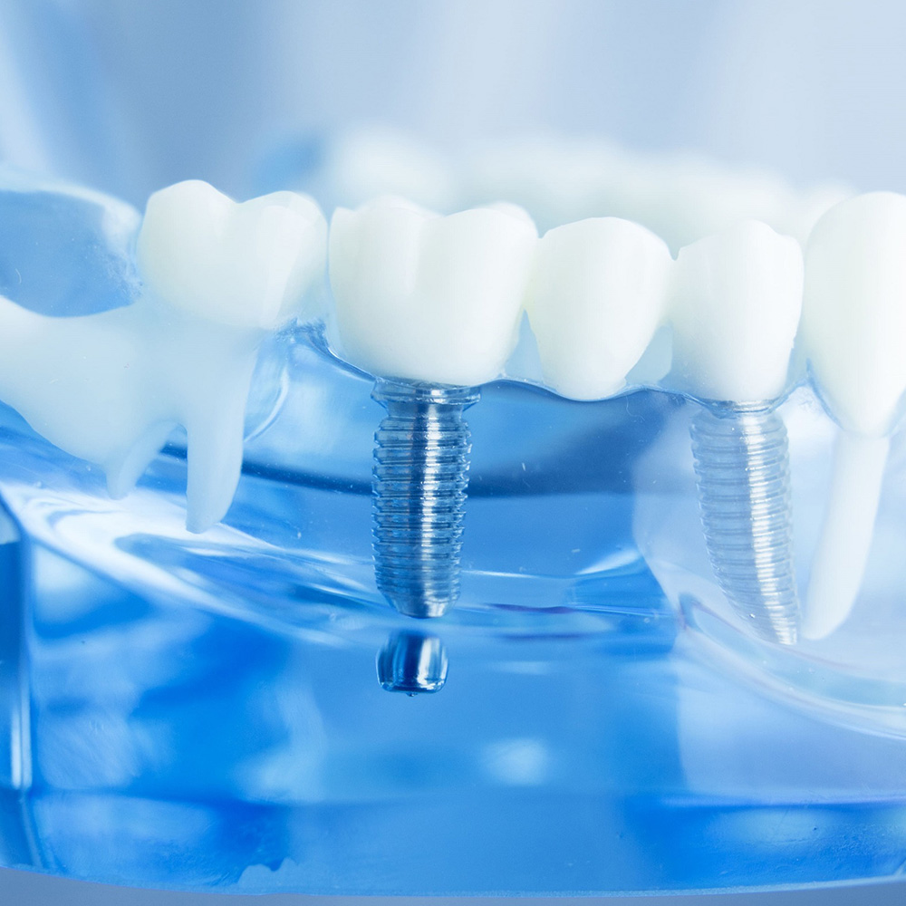 東十条の歯医者、医療法人社団医智会 Premium Dental Salon IKEIのインプラント治療