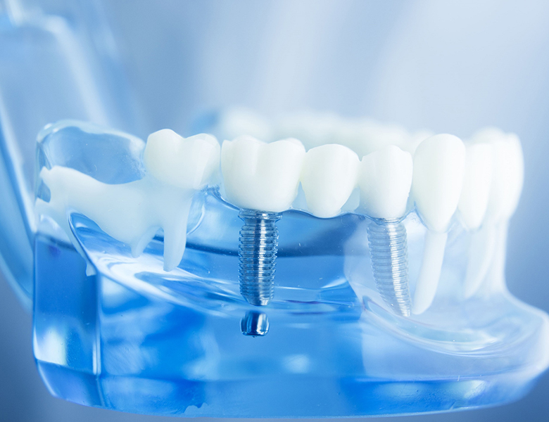 東十条の歯医者、医療法人社団医智会 Premium Dental Salon IKEIのインプラント治療