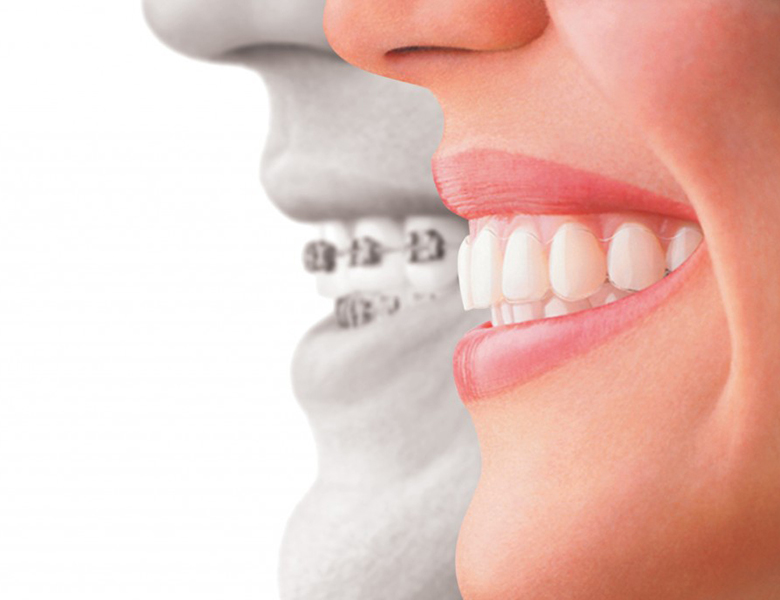 東十条の歯医者、医療法人社団医智会 Premium Dental Salon IKEIのマウスピース矯正