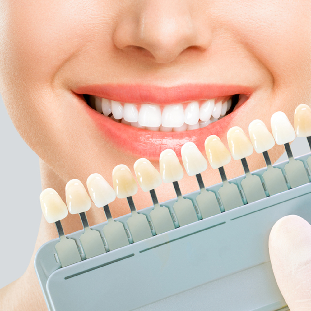 東十条の歯医者、医療法人社団医智会 Premium Dental Salon IKEIのホワイトニング