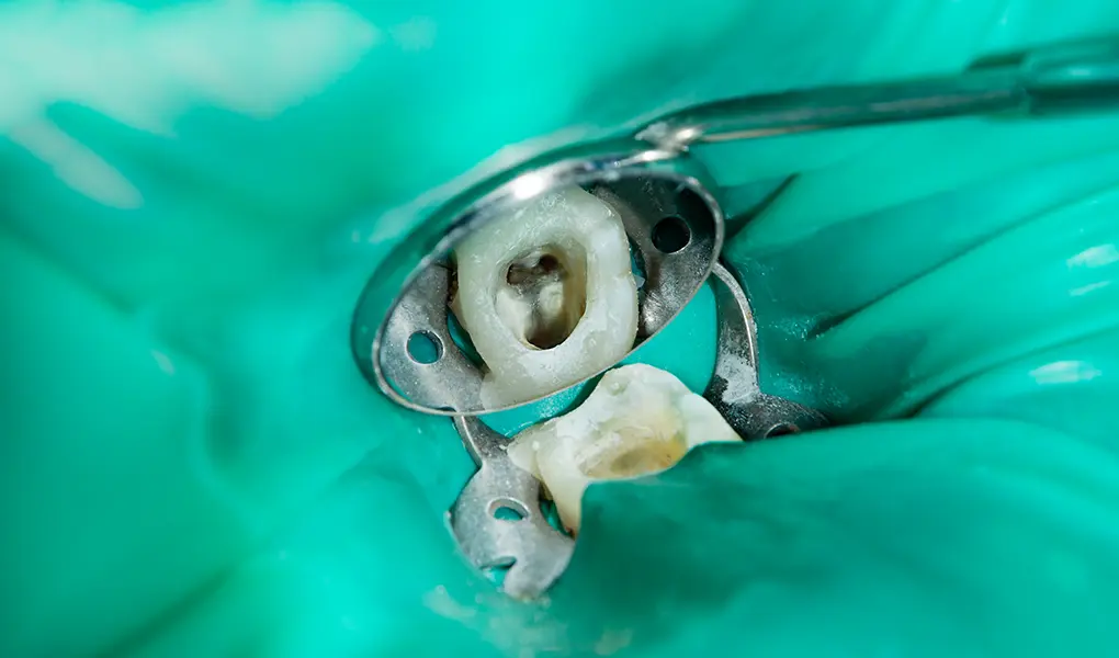 東十条の歯医者、医療法人社団医智会 Premium Dental Salon IKEIのマイクロスコープ精密治療