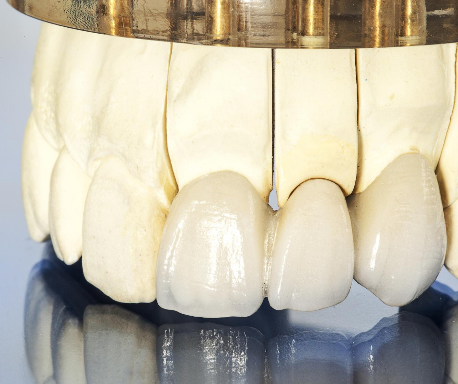 東十条の歯医者、医療法人社団医智会 Premium Dental Salon IKEIの審美・セラミック治療
